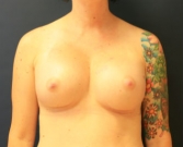 Feel Beautiful - Breast Augmentation San Diego Case 50 - After Photo